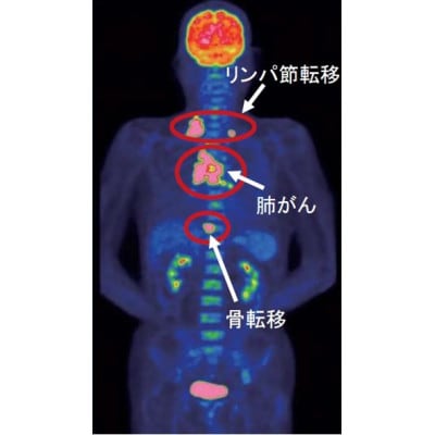 がんを早期発見するPET-CT装置によるがん検診 | 宮崎県宮崎市