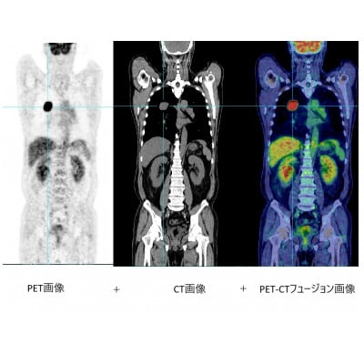 大分県別府市◆PET-CT全身がん検診【がんPETコース】(1名分)