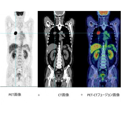 大分県別府市◆PET-CT全身がん検診◆MRI検診3部位付き【エグゼクティブコース】(1名分)
