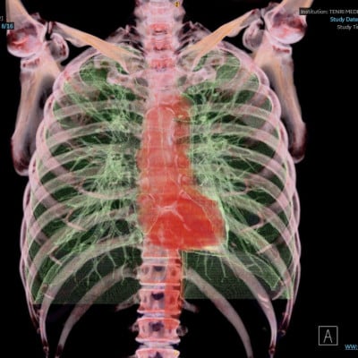 天理発  3D CT ( 頚部 ～ 骨盤 )+胆・肝・膵 MRI 健診